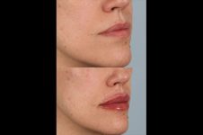 before and after facial rejuvenation female patient right angled view case 8788