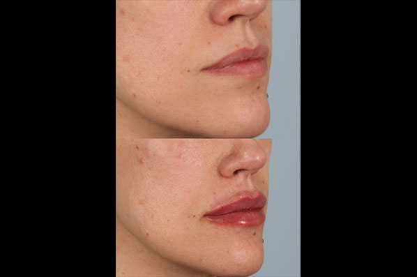 before and after facial rejuvenation female patient right angled view case 8788