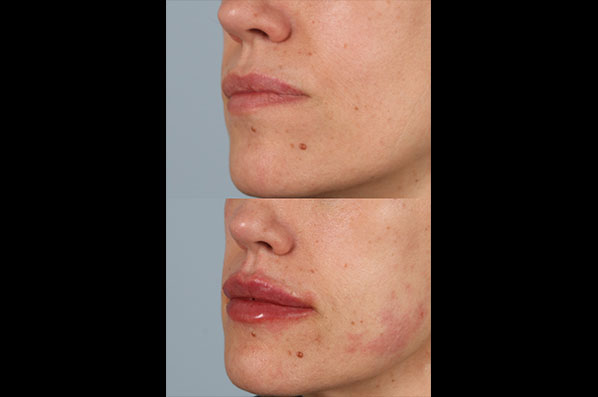 before and after facial rejuvenation female patient left angled view case 8788