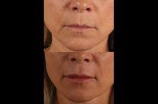 before and after facial rejuvenation female patient front view case 8794