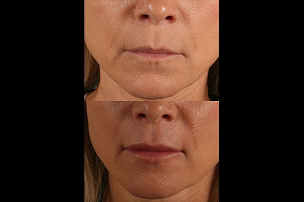before and after facial rejuvenation female patient front view case 8794