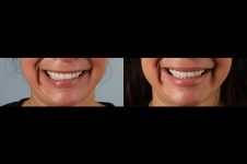 before and after facial rejuvenation female patient front view case 8798