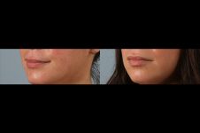 before and after facial rejuvenation female patient left angled view case 8798