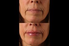 before and after facial rejuvenation female patient front view case 8801