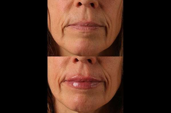 before and after facial rejuvenation female patient front view case 8801