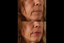 before and after facial rejuvenation female patient right angled view case 8801