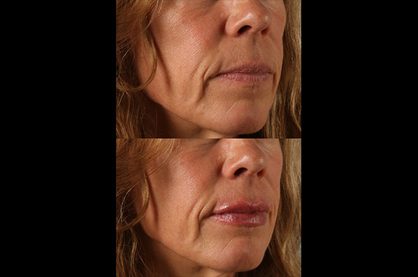 before and after facial rejuvenation female patient right angled view case 8801